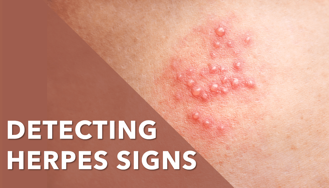 How To Spot Herpes Symptoms And Seek Proper Treatment